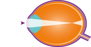myopic-eye-diagram.png