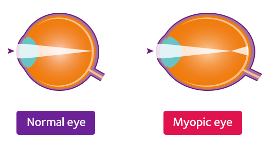Myopia.png